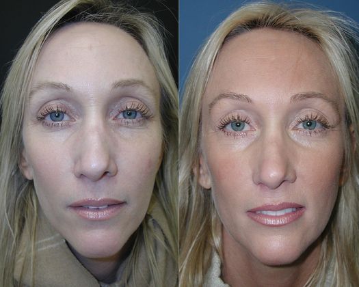Blepharoplasty Case 4