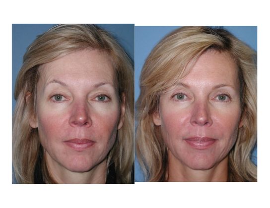 Blepharoplasty Case 1