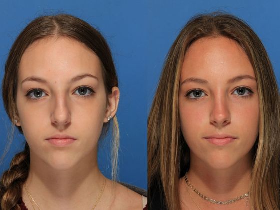 Rhinoplasty: Case 1