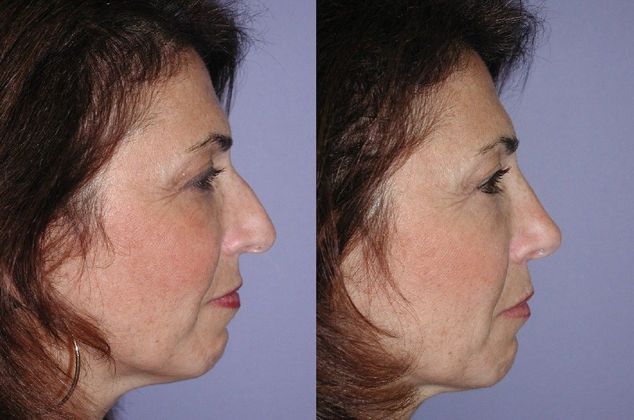 Rhinoplasty Case 4