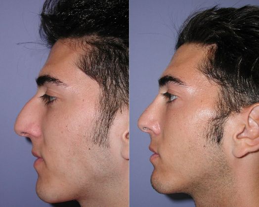 Rhinoplasty Case 5