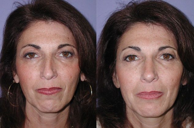 Rhinoplasty: Case 4