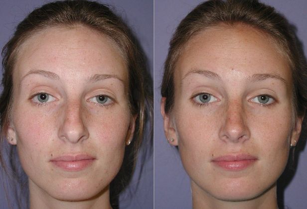 Rhinoplasty Case 3