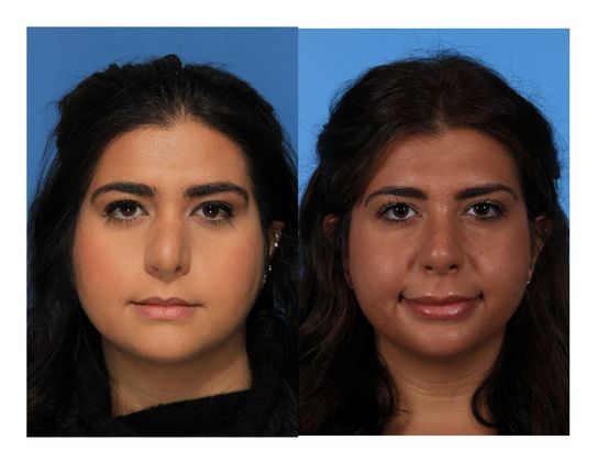 Revision Rhinoplasty  Case 2