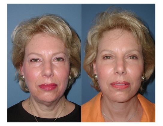 Blepharoplasty Case 2