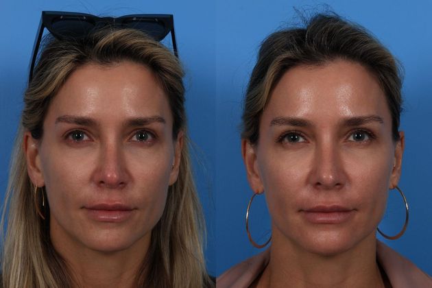 Threadlift Cases