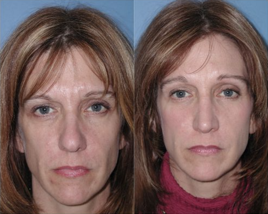 Endoscopic Browlift Case