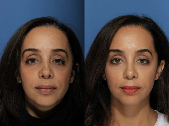 Revision Rhinoplasty Cases