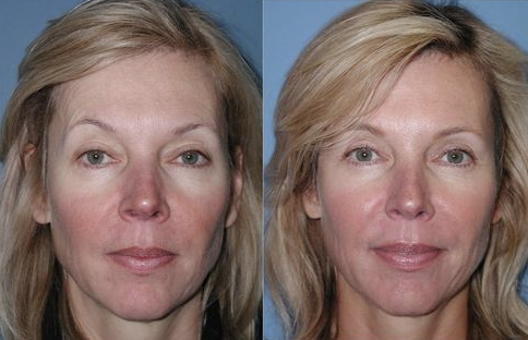 Blepharoplasty Before and After