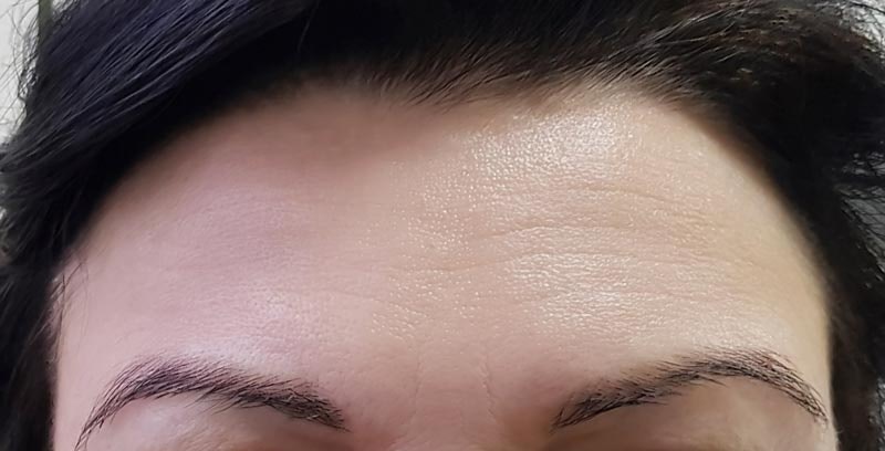 Forehead after injectables