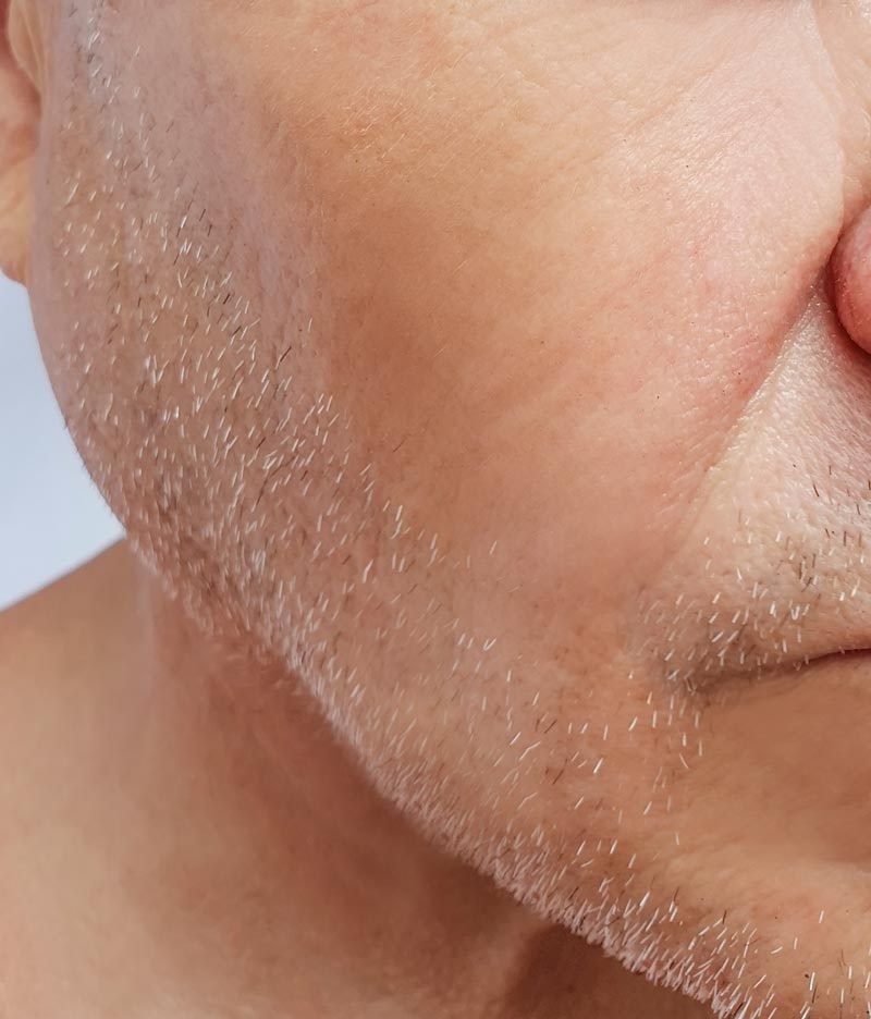 Man's jowl area after dermal fillers