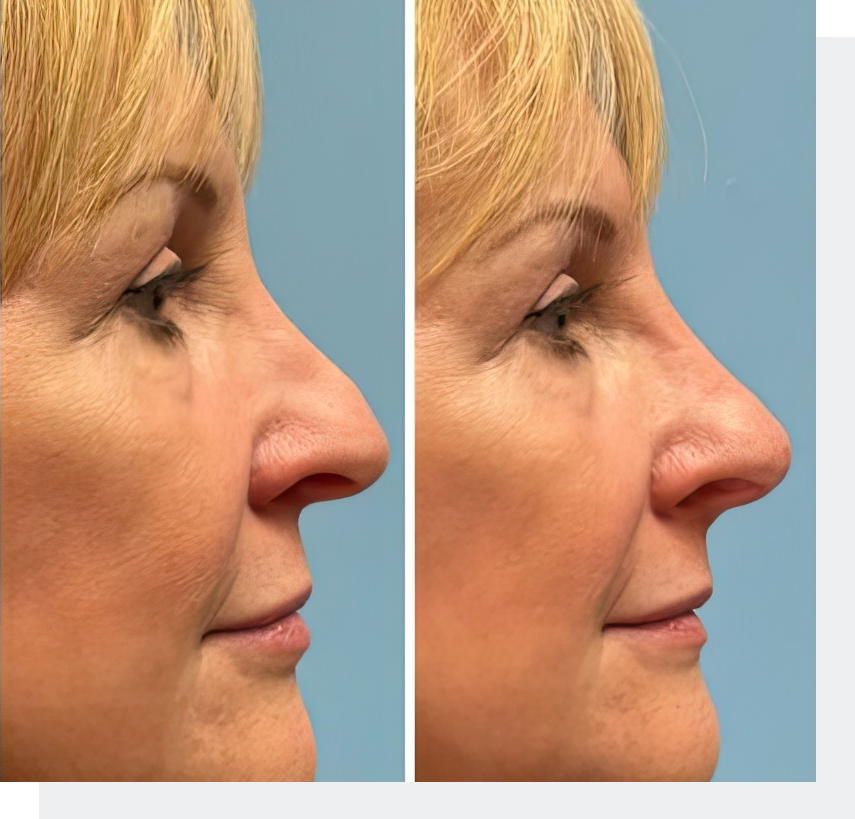 Real patient before and after liquid rhinoplasty