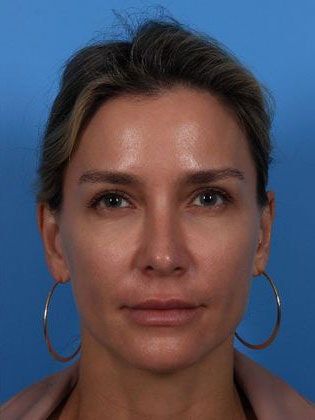 Dr. Jon Turk's patient after thread lift