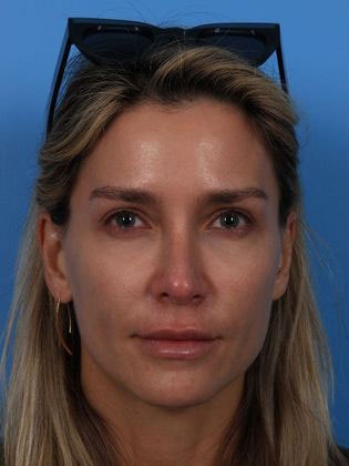 Dr. Jon Turk's patient before thread lift